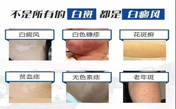 <a href=http://www.bb106.com/ target=_blank class=infotextkey>白癜风</a>毛庆栋详谈染发加速白斑患者白斑的扩散