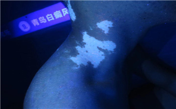 雷鸣介绍青岛那个医院的白癫风最好 雷鸣介绍青岛那个医院的白癫风最好