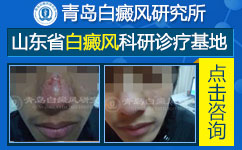 白癜风诊断该如何做 白癜风诊断该如何做