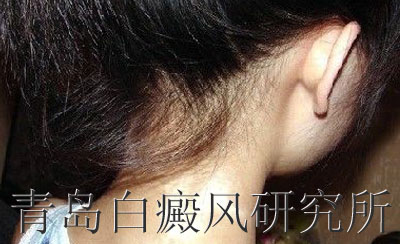 白癜风治疗方法有哪些 白癜风治疗方法有哪些