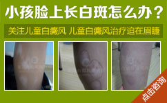儿童白癜风的治疗 儿童白癜风的治疗