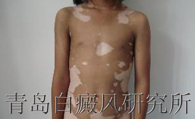 青岛治疗白癜风哪家医院好 青岛治疗白癜风哪家医院好